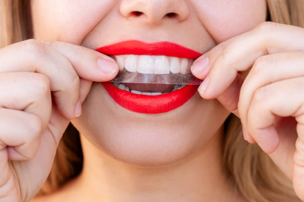 teeth whitening strips on a woman's teeth