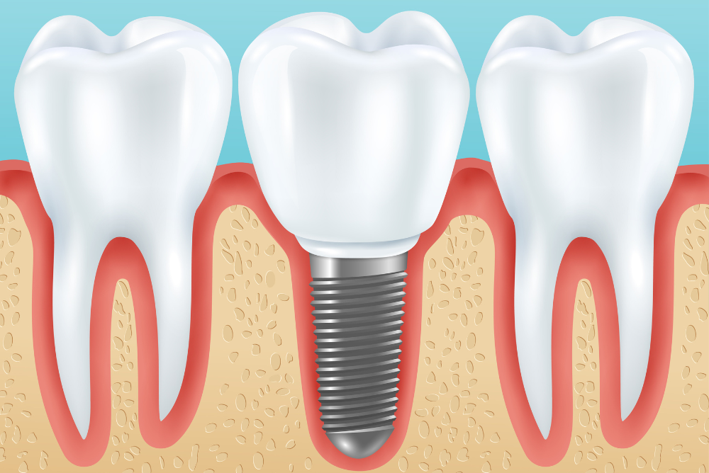 Searching for dental implants near me or dental implants in Vinings? Discover how our expert implant solutions restore smiles with lasting results. Book your consultation today!
