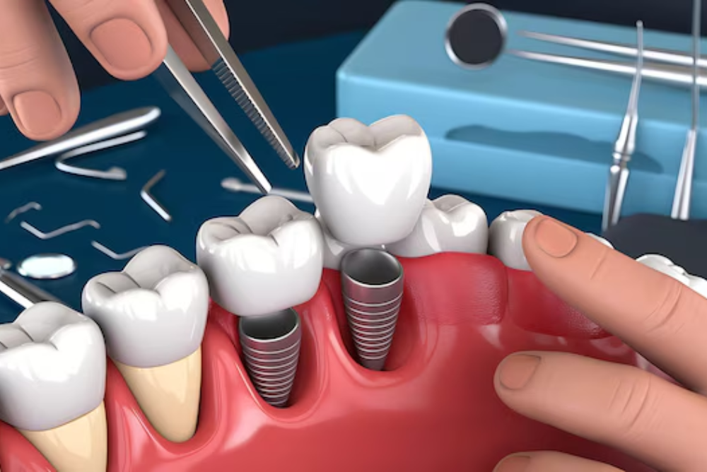 the step by step dental implant process in vinings