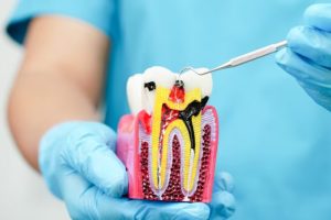 is a small cavity a big problem